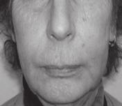 La paciente se había inyectado siliconas en labios para corregir las arrugas dos años y medio antes del inicio de los síntomas. Fig. 2. Paciente de la Fig.