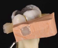 tenidas, se colocó el órgano dentario en el equipo INSTRON 3365 y, con la punta de 3 mm, se aplicó fuerza de cizallamiento con una celda