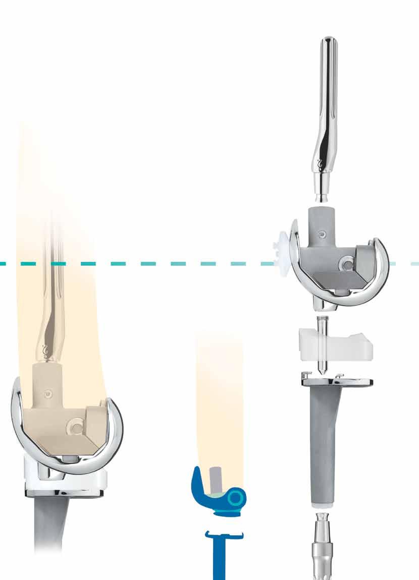 Conservación de hueso e instrumentación sencilla Muchos diseños de rodillas con bisagra rotatoria requieren una resección de hueso significativa para dar cabida al voluminoso mecanismo de bisagra.