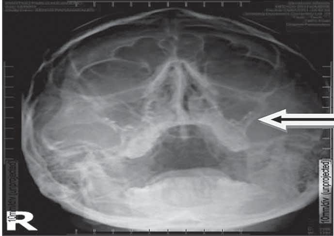 38 REVISTA FASO AÑO 19 - Nº 3-2012 Angiografía Postembolización con geolfan Se realizó el tratamiento quirúrgico del angio broma nasofaríngeo con extensión a la base del cráneo mediante un abordaje