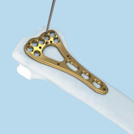 Implantación Reduzca la fractura. El método de reducción depende en cada caso del tipo de fractura. Aplique la placa para que se ajuste a la superficie volar.