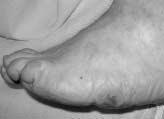 ño 71 Número 4 Diciembre de 2006 Tratamiento de la artropatía de Charcot 349 C D dad sin ulceraciones.