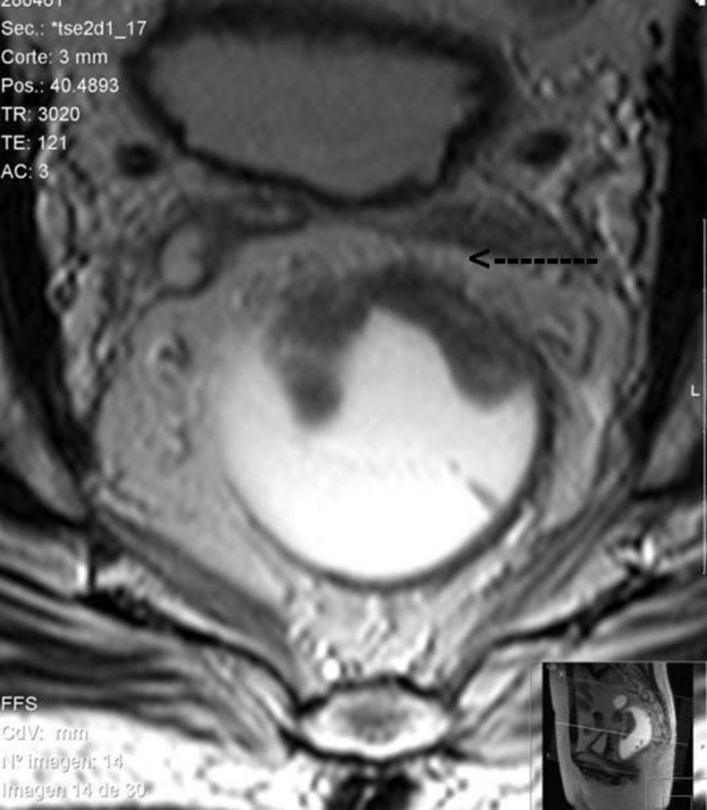 Fig. 8: Adenocarcinoma rectal con fibrosis en el tejido adiposo del mesorrecto.