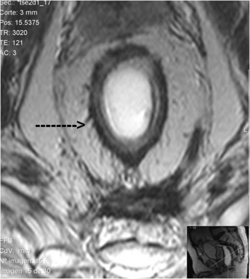 Fig. 3: Paciente operado de carcinoma de recto más radioterapia.
