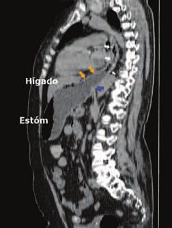 L unión gstroesofágic (flech lnc) se desplz junto l región superior del estómgo hci el medistino posterior por encim del difrgm, deido un