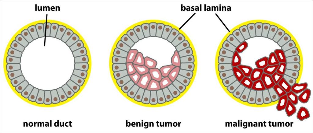 Cáncer : conceptos básicos - tumor (neoplasia): masa de células generada a partir de la proliferación descontrolada de una célula inicial tumor benigno: neoplasia no invasiva, con