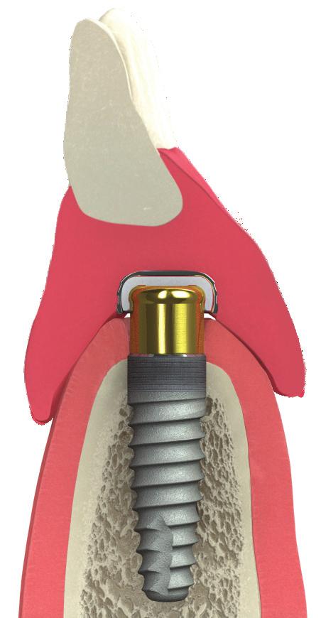 composición de una sobredentadura dentadura pilar que asegura la dentadura aleación de titanio biocompatible mandíbula
