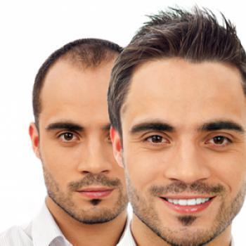 injertos por sesión puede ser muy variable, en función de la super ficie de alopecia a cubrir, de la cantidad de cabello en la zona donante, de las características del cabello de cada paciente, del