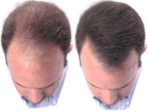 Quién puede beneficiarse de la cirugía de restauración del cabello Cualquier persona que haya experimentado una pérdida permanente del cabello puede ser candidato: Varones con alopecia en patrón