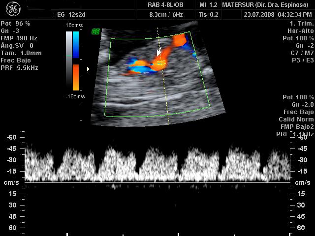 Si el feto se encuentra situado con el dorso anterior o posterior se utiliza la técnica sagital, donde el DV puede ser apreciado en toda su extensión partiendo del seno portal.