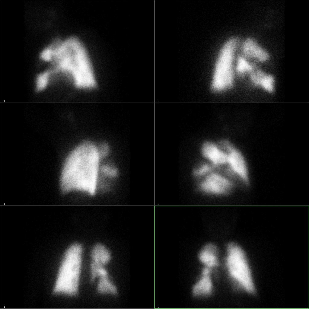 Figura 7: Gammagrafía de perfusión pulmonar