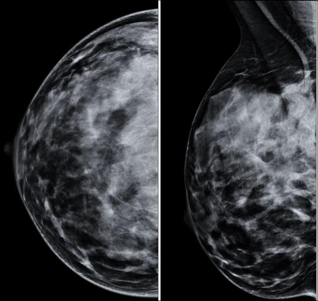 Fig. 1: Mamografía proyección OML de MI. Mastopatía diabética. Asimetría de densidad de la distribución del tejido fibroglandular con mayor densidad en CSE-cola axilar.
