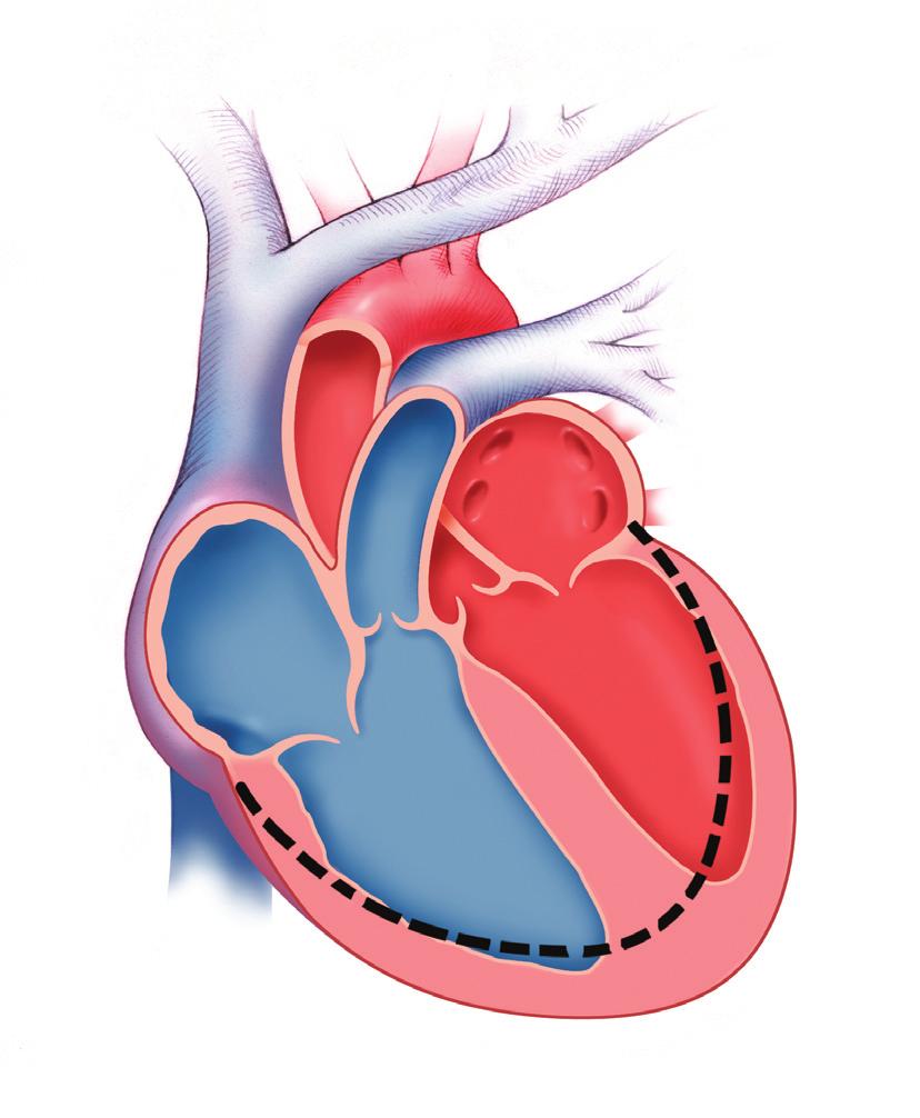 Insuficiencia cardiaca El corazón puede empezar a fallar por varios motivos. Un motivo puede ser el resultado del daño muscular debido a un infarto de miocardio.