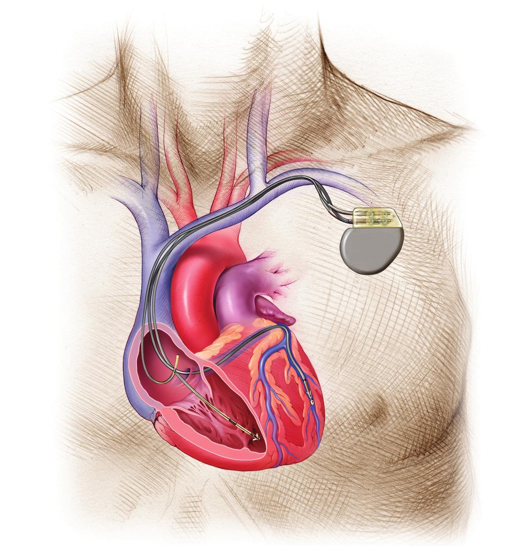 Cable en la aurícula derecha TRC-P implantado Cable dentro de la vena coronaria sinusal Cable en el ventrículo derecho Figura 5. Un sistema TRC-P implantado.