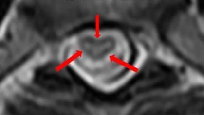 Esclerosis lateral amiotrofica (ELA) Dentro de los hallazgos morfológicos más frecuentes en la RM se
