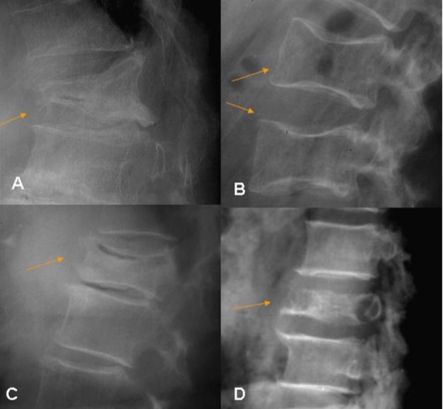 FRACTURAS SECUNDARIAS A OSTEOPOROSIS Y TUMORES A. Fractura osteoporótica en cuña B. Fractura osteoporótica en diábolo C.