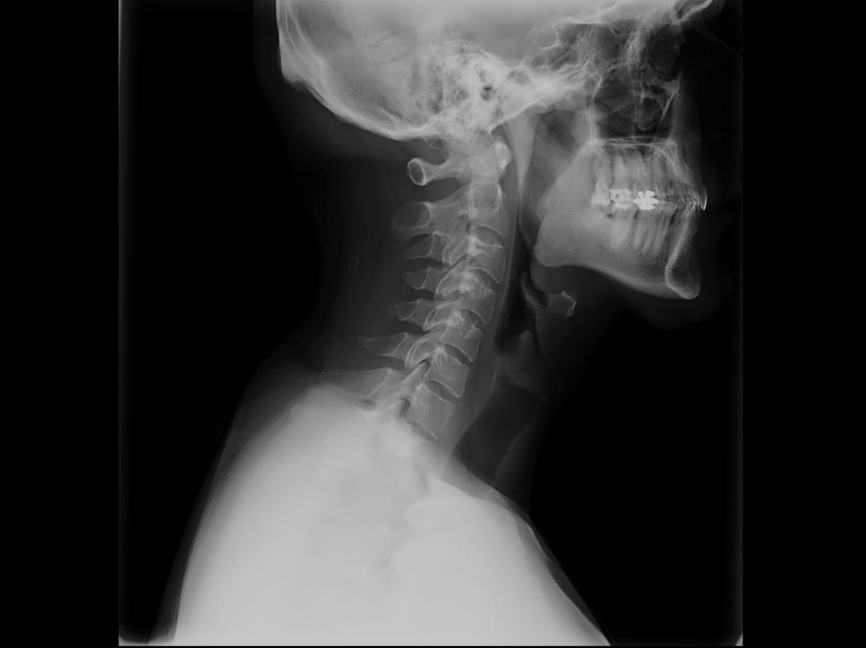 1.- Técnica adecuada: CARACTERÍSTICAS 7 vértebras cervicales + 1ª vértebra