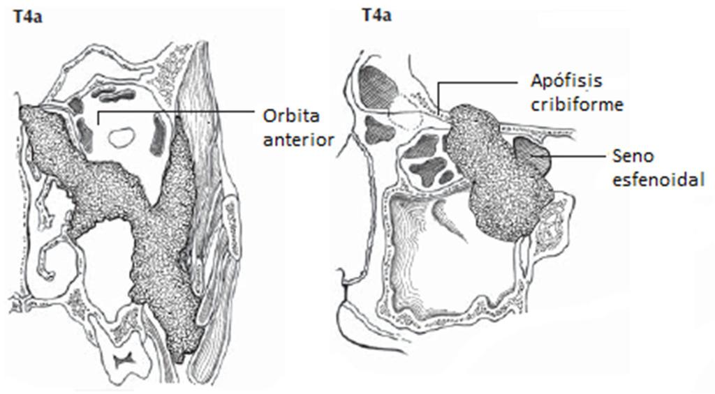 T=tamaño tumoral Seno maxilar T4a Tumor que invade alguna de las siguientes localizaciones: contenido orbitario