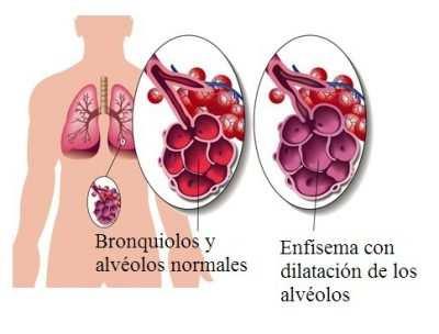 FORMAS CLINICAS DE LA EPOC ENFISEMA PULMONAR: enfermedad de los alveolos pulmonares.