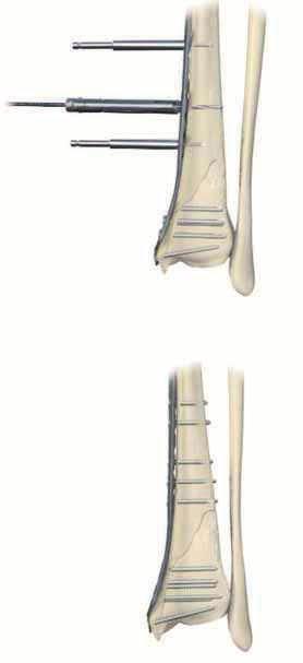 Sección B: Placa Tibial Distal Medial con Bloqueo Para insertar tornillos de bloqueo en la diáfisis, colocar la Cánula para Tornillos de Bloqueo de 3,5 mm, con la Guía de Broca de Bloqueo de 2,7 mm