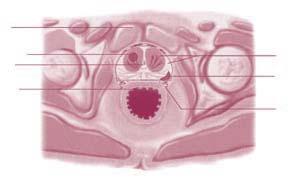 Figura 4. La próstata, el adenoma y el tumor (corte transversal-horizontal) Pubis Cáncer en el adenoma Uretra Recto Próstata Cáncer en la zona posterior Nervios Se trata de un cáncer frecuente?
