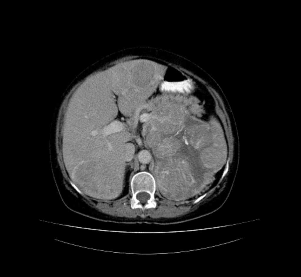 Fig. 13: Mujer de 52 años que refiere aumento del diámetro abdominal y dolor en epigastrio. TC abdominal con contraste en fase portal.