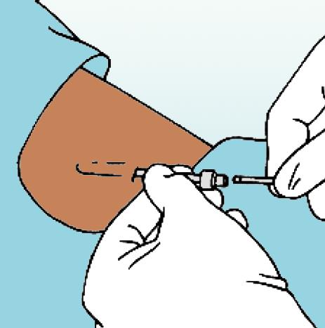 Cuando la punta sea visible en la incisión, tómela con las pinzas Crile/Kelly rectas y quite suavemente la varilla sin retorcerla ni forzarla, dado que puede quebrarse.