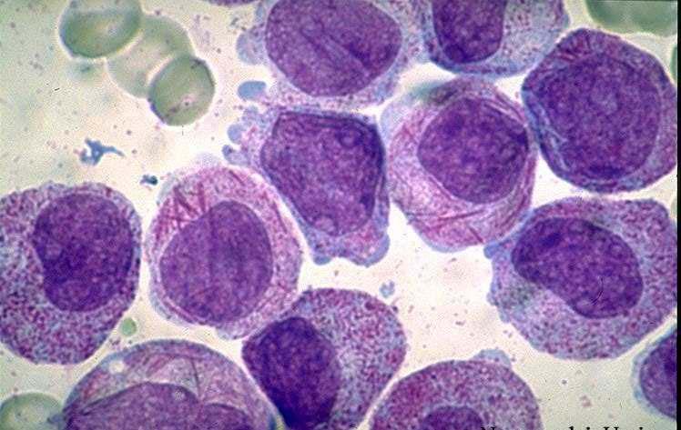 Leucemia PromielocÍtica Aguda Tendencia procoagulante Alteraciones hemostáticas Factor tisular