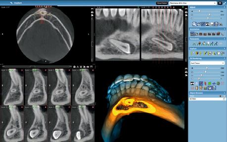El módulo también permite a los usuarios comparar imágenes CBCT y de resonancia magnética una al lado de la otra, con lo que se proporciona una amplia visión de la anatomía del paciente.