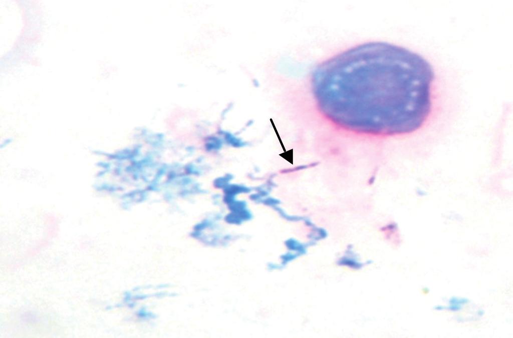 Tuberculosis mediastinal diagnosticada por aspiración transbronquial guiada por ultrasonido; presentación de un caso Figura 3. Tinción Zihel Neelsen positiva. Figura 4.