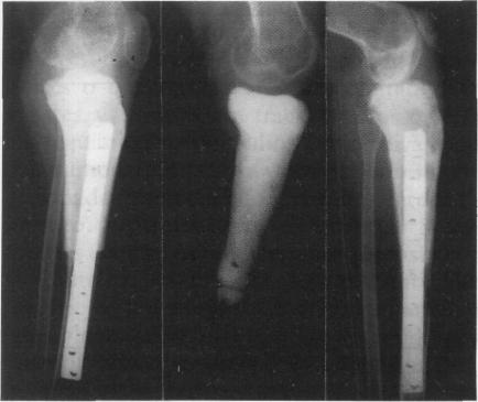 C y D: Radiografía de frente y perfil de rodilla a los 3 años de evolución, donde se observa la consolidación de la fractura luego del agregado de injerto autólogo y cambio de la osteosíntesis.