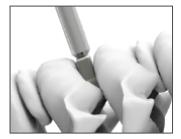 4. Introducción del implante Utilice el colocador para introducir el implante en el espacio discal.