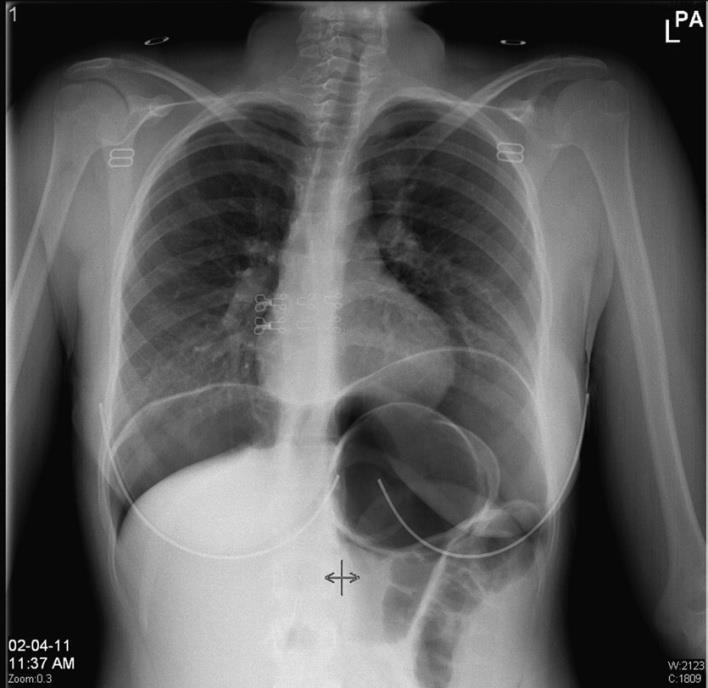 Ultrasonido de abdomen: gran cantidad de aire en los intestinos y sin otros hallazgos. RX de tórax: una gran cantidad de aire por debajo de los dos diafragmas.