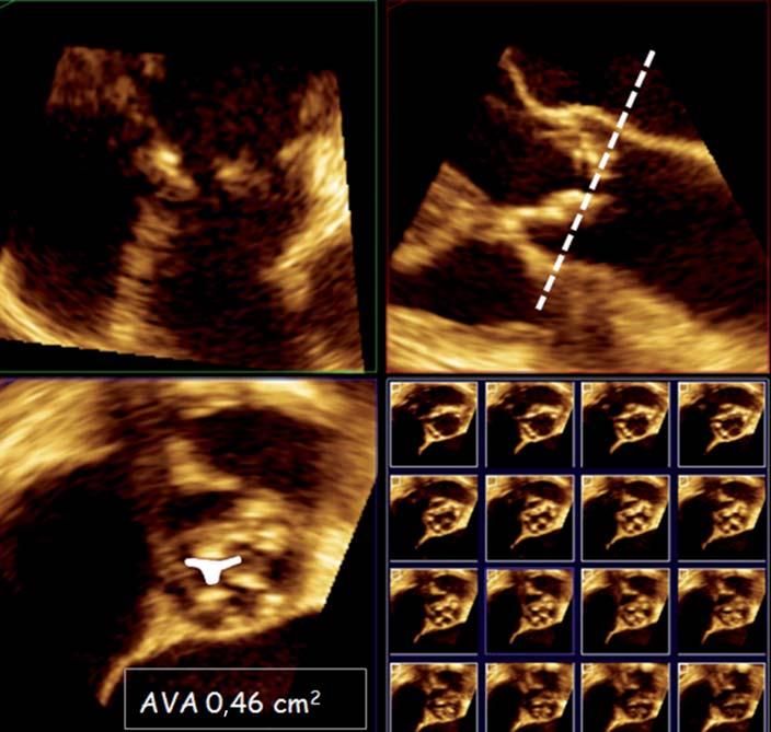 Cardiología clínica Sección V - Patología de pericardio y válvulas Figura 30.2. A: ETE bidimensional en eje corto de la válvula aórtica, en un paciente con estenosis grave.