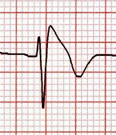Proarritmia inducida por fármacos Heart Rhythm 2009;6:1342-1344 Circulation 2010;122:1426-1435 Potencial torsadogénico Potencial brugadogénico Distintivo ECG Prolongación del QT Supadesnivel convexo