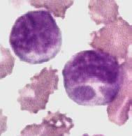 50 M M Figura 5. Frotis de Capa Blanca donde se observan las inclusiones intracitoplasmáticas basófilas correspondientes a las mórulas (M) en células mononucleares.