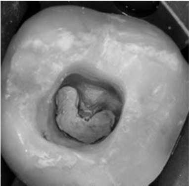 En premolares superiores y raíz distal de molares