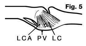 LESIONES IFP DE LOS DEDOS LARGOS Figura 4: Detalle de la interposición de la placa volar y el lazo tendinoso alrededor del cuello del metacarpiano 1.