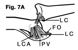 A. Quintana Guitián 2. Esguince de la placa palmar: Es el resultado de un mecanismo de hiperextensión, produciéndose habitualmente un hematoma en la cara volar de la articulación, así como edema.