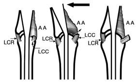 Lesiones de los ligamentos de los dedos 1. Ligamento lateral (LC), el cual se dirige desde la cabeza del metacarpiano hasta la base de la falange proximal, tensándose con la flexión articular. 2.