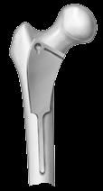 femoral 2 Apertura del fémur proximal con el
