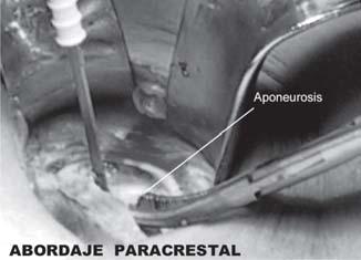 anterior, apertura de la aponeurosis posterior del recto, oblicuos y transverso y finalmente del peritoneo; 5) realización de la apendicectomía de manera habitual, preferentemente con el apéndice