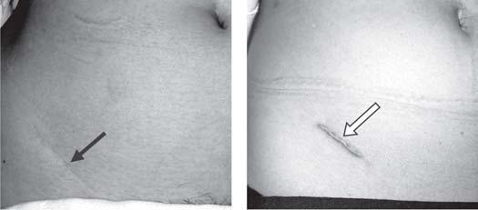 Dr. Rodea Figs. 5 y 6. Fotografías que muestran la cicatriz de la incisión paracrestal en una paciente de 50 años (Flecha negra) y la cicatriz hipertrófica en una mujer de 26 años (Flecha blanca).