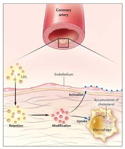 El concepto de la arteriosclerosis, como enfermedad inflamatoria Oxidación de las LDL Activación de factor de transcripción NFkB