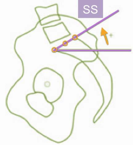 Pendiente Sacra (Sacral Slope) Inclinación del planllo de S1 Modificable con anteversión/ retroversión pélvica Inversamente relacionado con