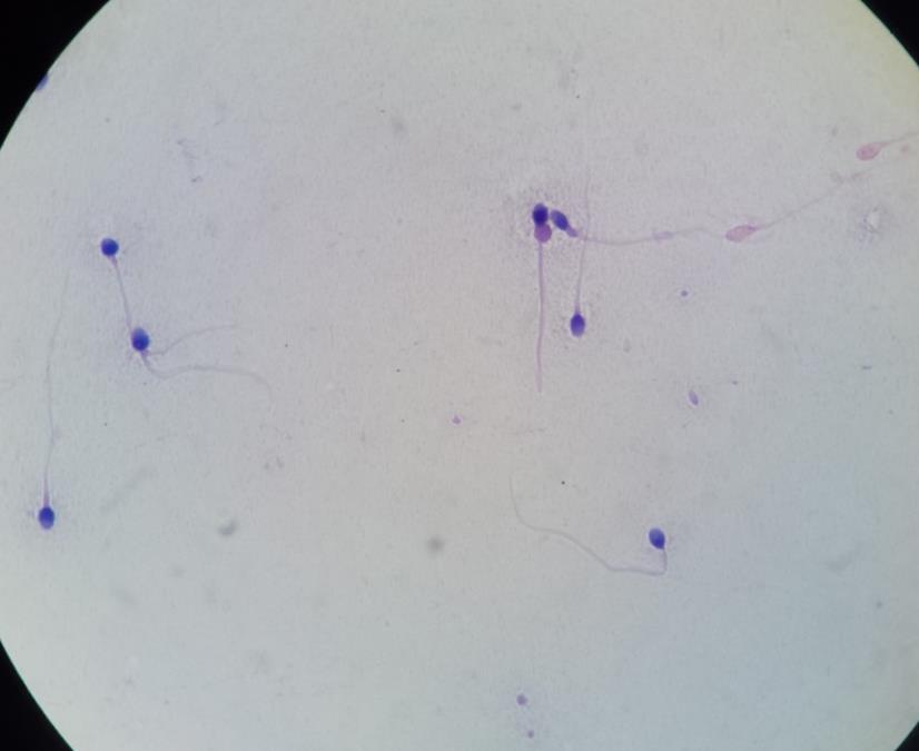 Fig. 7 Espermatozoide con anomalía