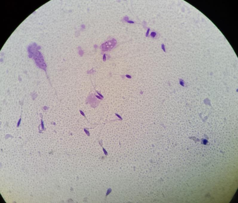 Fig. 9 Espermatozoides con anomalías en cola: enrolladas, angulados y bicaudales.