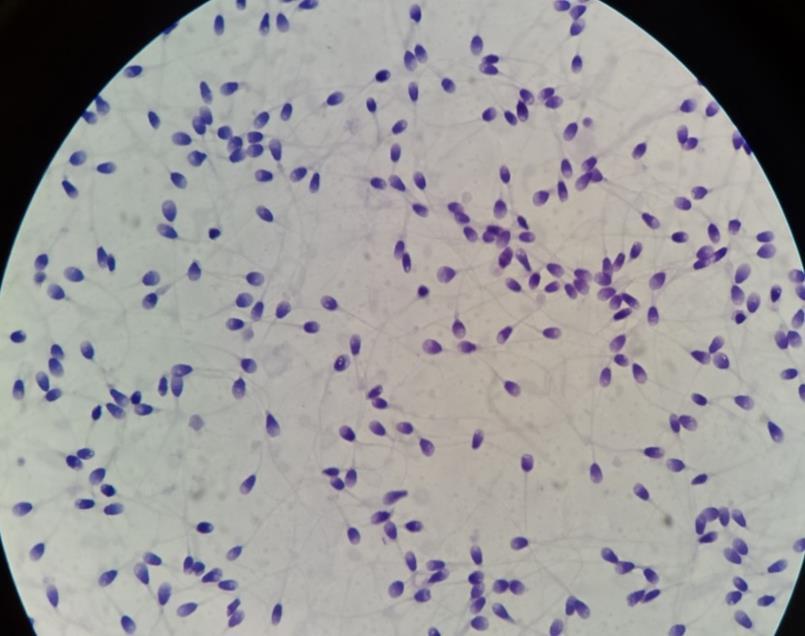 Fig. 10 Espermatozoide con anomalías de flagelo doble y cabeza bicéfala.