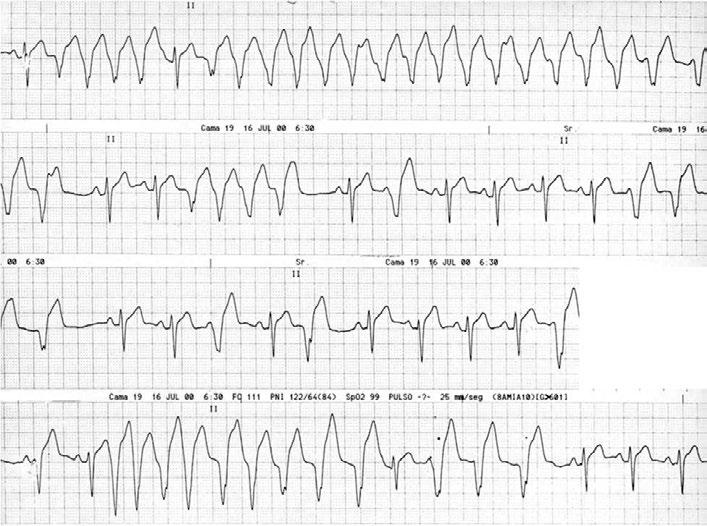 63 06 Figura 4: Taquicardia ventricular monomorfa. Registro de una paciente de 16 años que consultaba por episodios sincopales frecuentes. A: no sostenida. B: Sostenida.