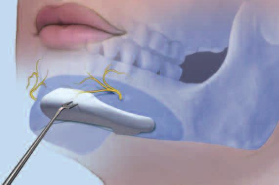 Separe el implante mentoniano por su unión central para insertarlo en dos partes. Puede servirse del instrumento posicionador para facilitar la colocación del implante.